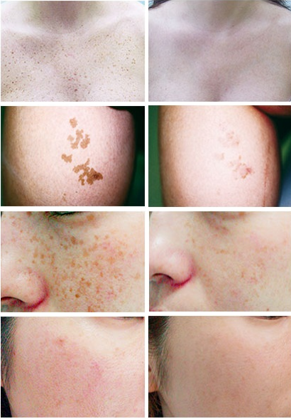 Лазерные процедуры Яхрома