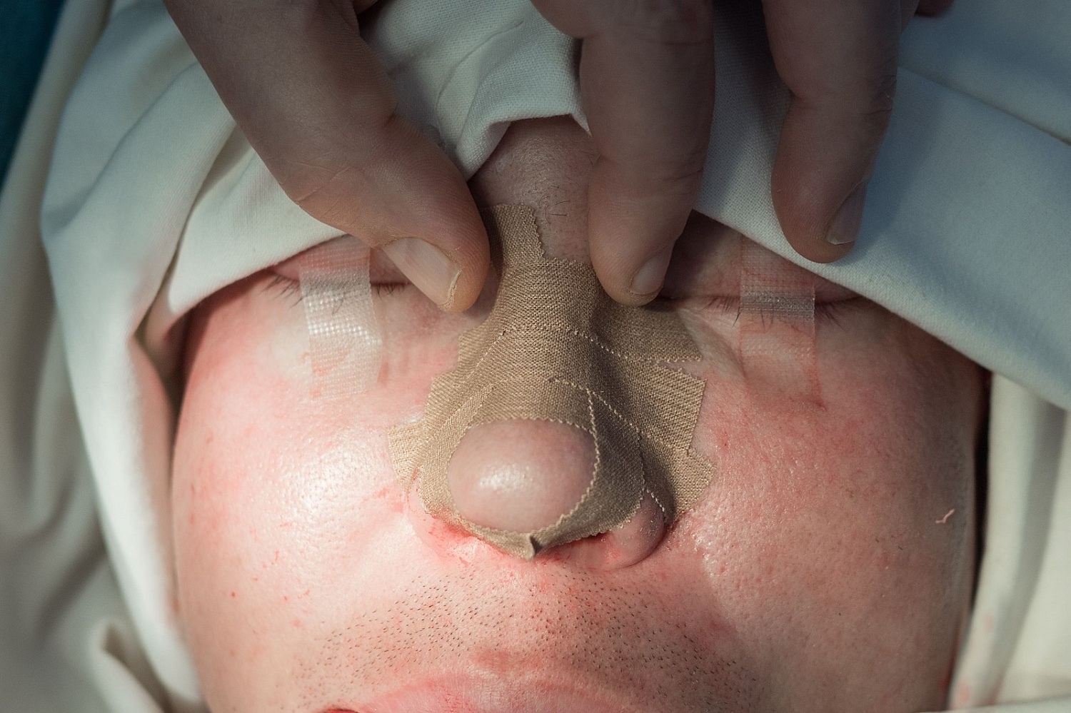 Ринопластика (пластика носа)